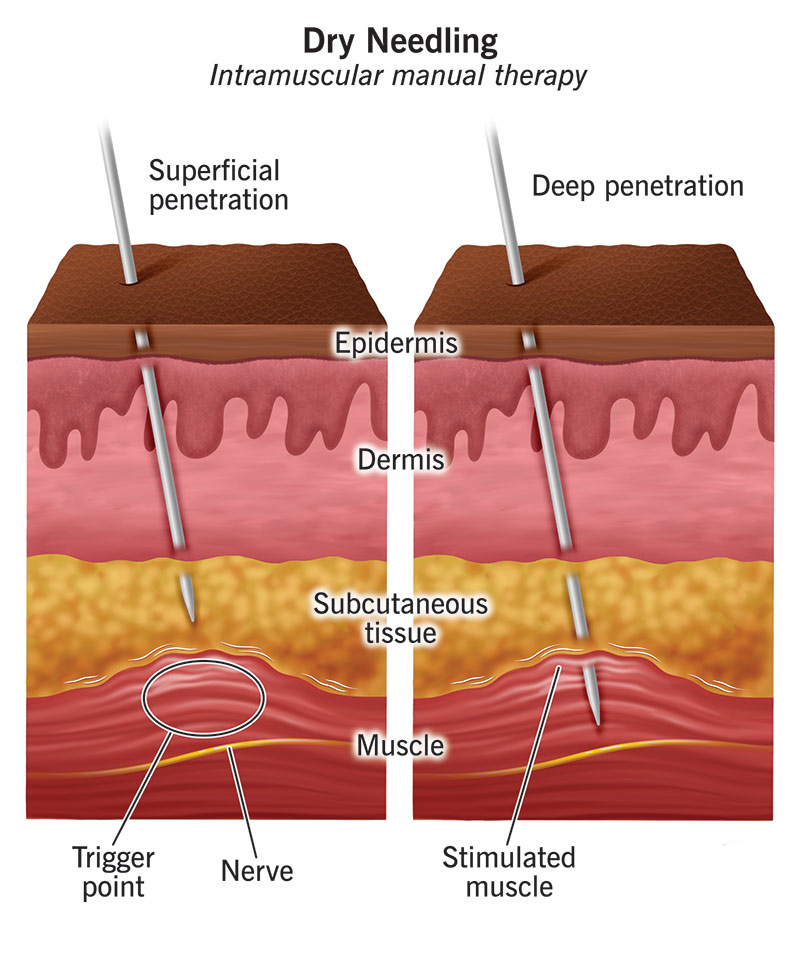 การฝังเข็มแบบแห้ง (Dry Needling)