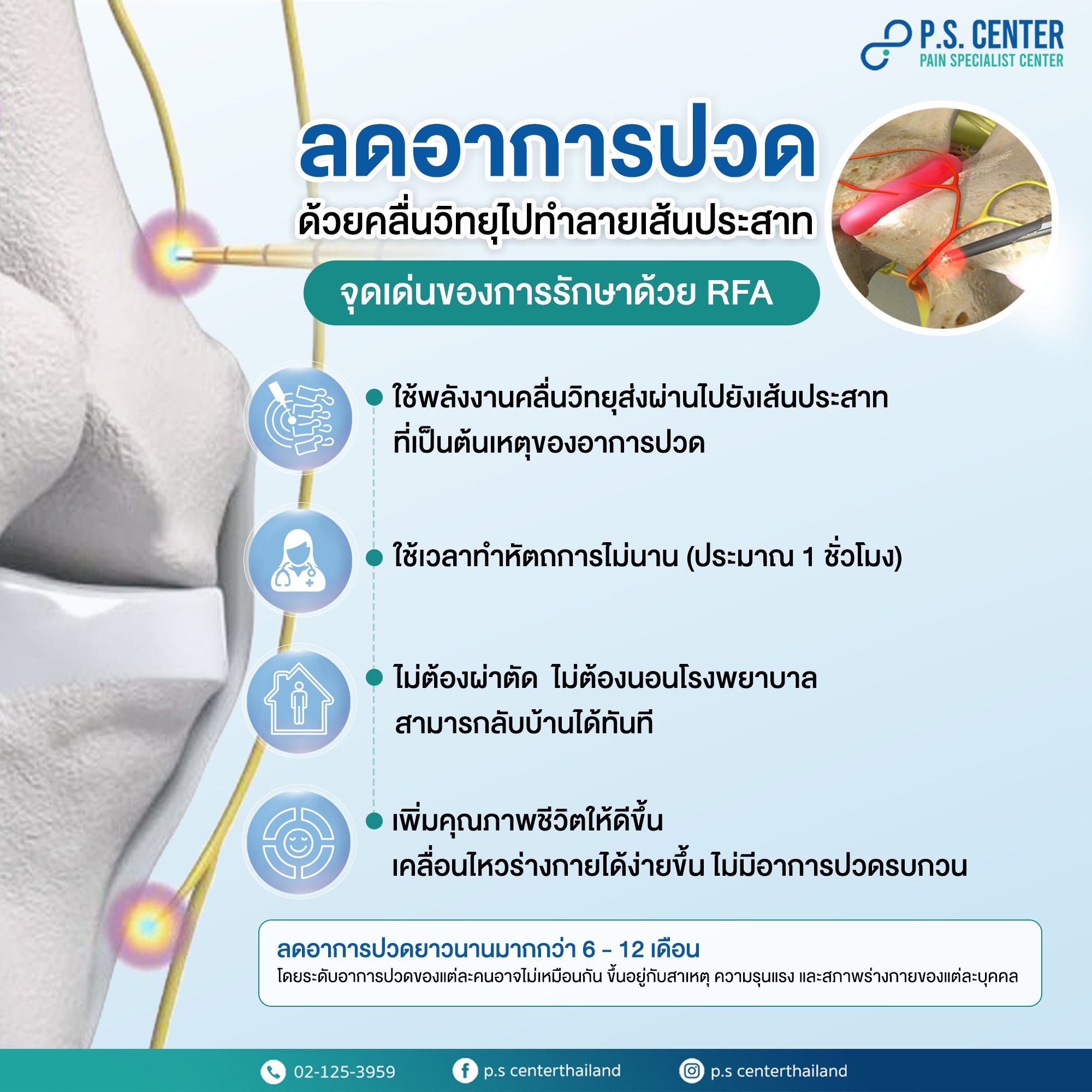 RFA จี้เส้นประสาทด้วยคลื่นวิทยุ