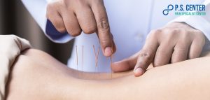 การฝังเข็มแบบแห้ง (Dry Needling)