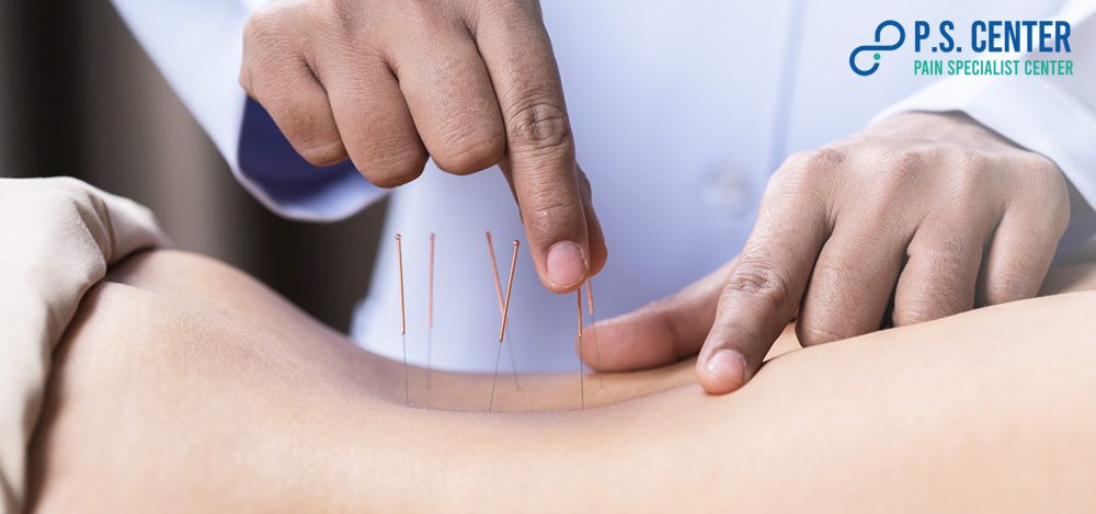การฝังเข็มแบบแห้ง (Dry Needling)